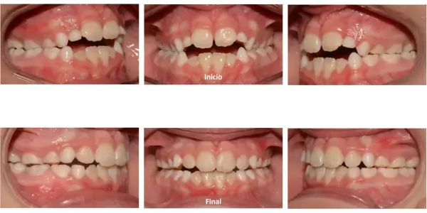 Niño con mordida abierta antes y después. Las imágenes muestran la corrección de la alineación dental, logrando una oclusión perfecta.