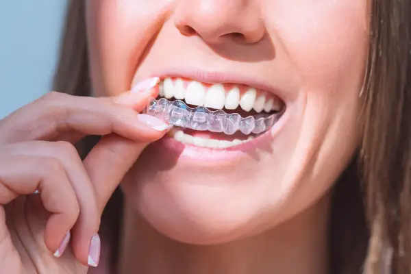 Mujer se coloca un alineador transparente. Para mantenerlos impecables y evitar que el Invisalign amarillo, es clave una buena higiene.