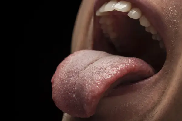 Primer plano de una boca abierta mostrando la lengua rosada con un bulto blanco en la lengua.